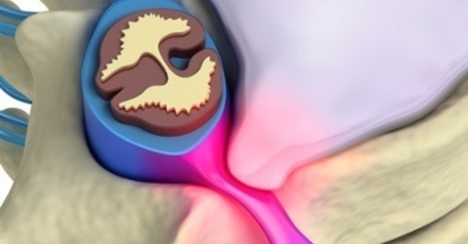 When are Cincinnati Chiropractors and Low Back Exercises Appropriate? image