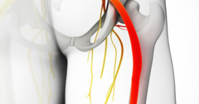 What You Need To Know About Sciatica image