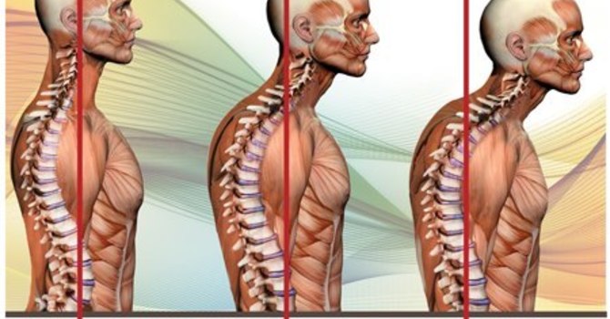 Learn The #1 Risk Factor for Recurrent Neck pain image